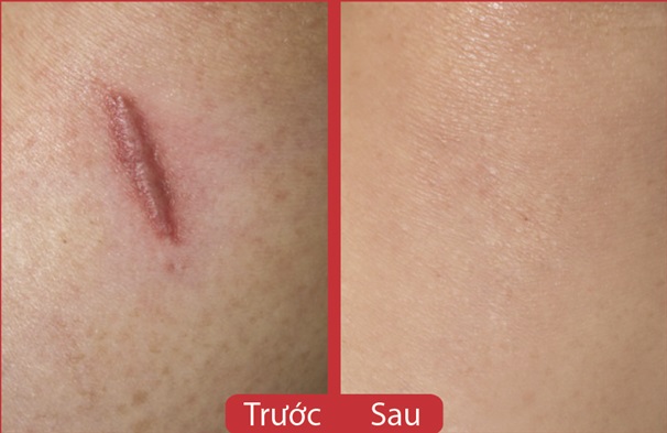 Kết quả sau 8 tuần trị sẹo lồi bằng Scarguard 15ml