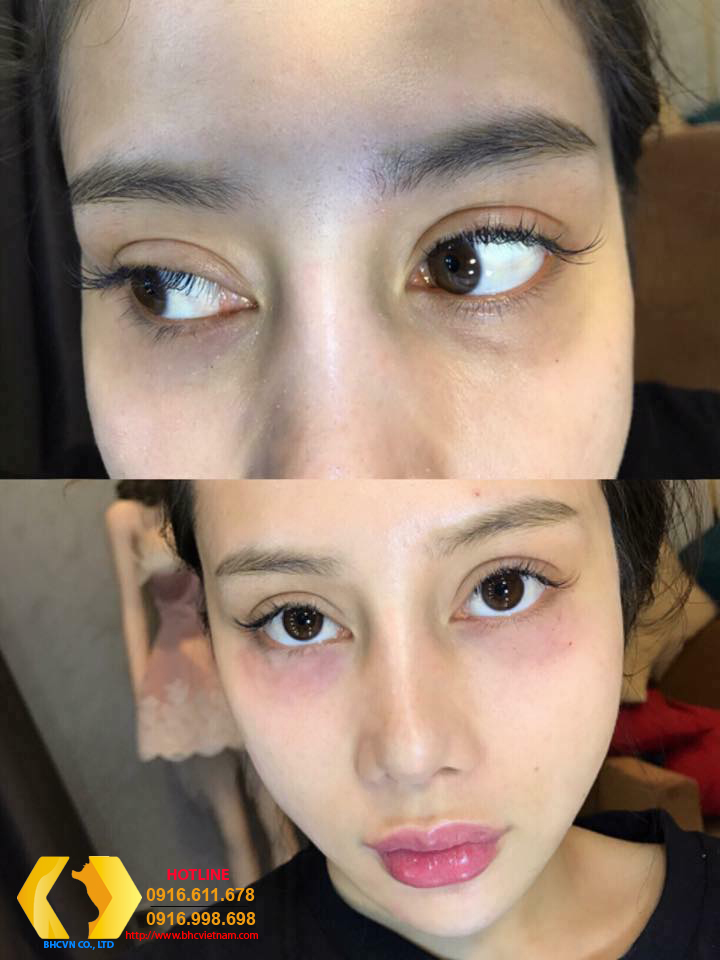 Hình ảnh Trước và Sau khi sử dụng Lumi Eyes