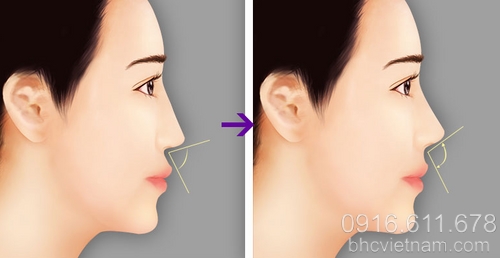 Cách làm cho mũi cao bằng phương pháp phẫu thuật
