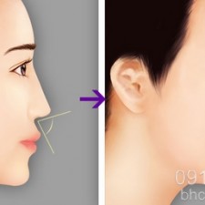 Có nên chọn phương pháp nâng mũi sline 3d không?
