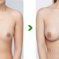 Đặt ngực ở đâu đẹp và an toàn?