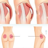 Lifting the buttocks of laparoscopic pain?