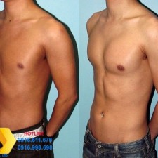 Nâng ngực cho nam giới: Xu hướng ngày càng hot