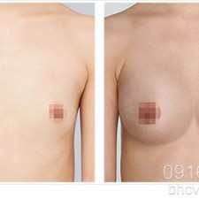 Những phương pháp phẫu thuật nâng ngực an toàn nhất 2017