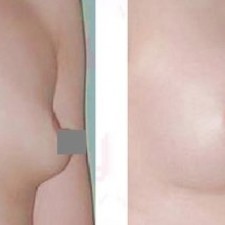 Tìm hiểu về phẫu thuật nâng ngực có nguy hiểm không?